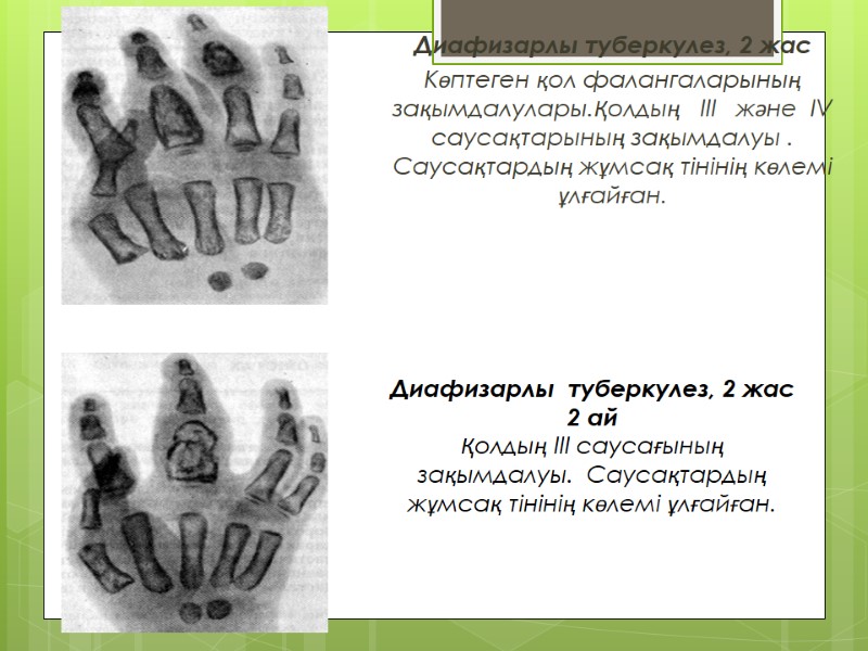 Диафизарлы туберкулез, 2 жас Көптеген қол фалангаларының зақымдалулары.Қолдың   III   және